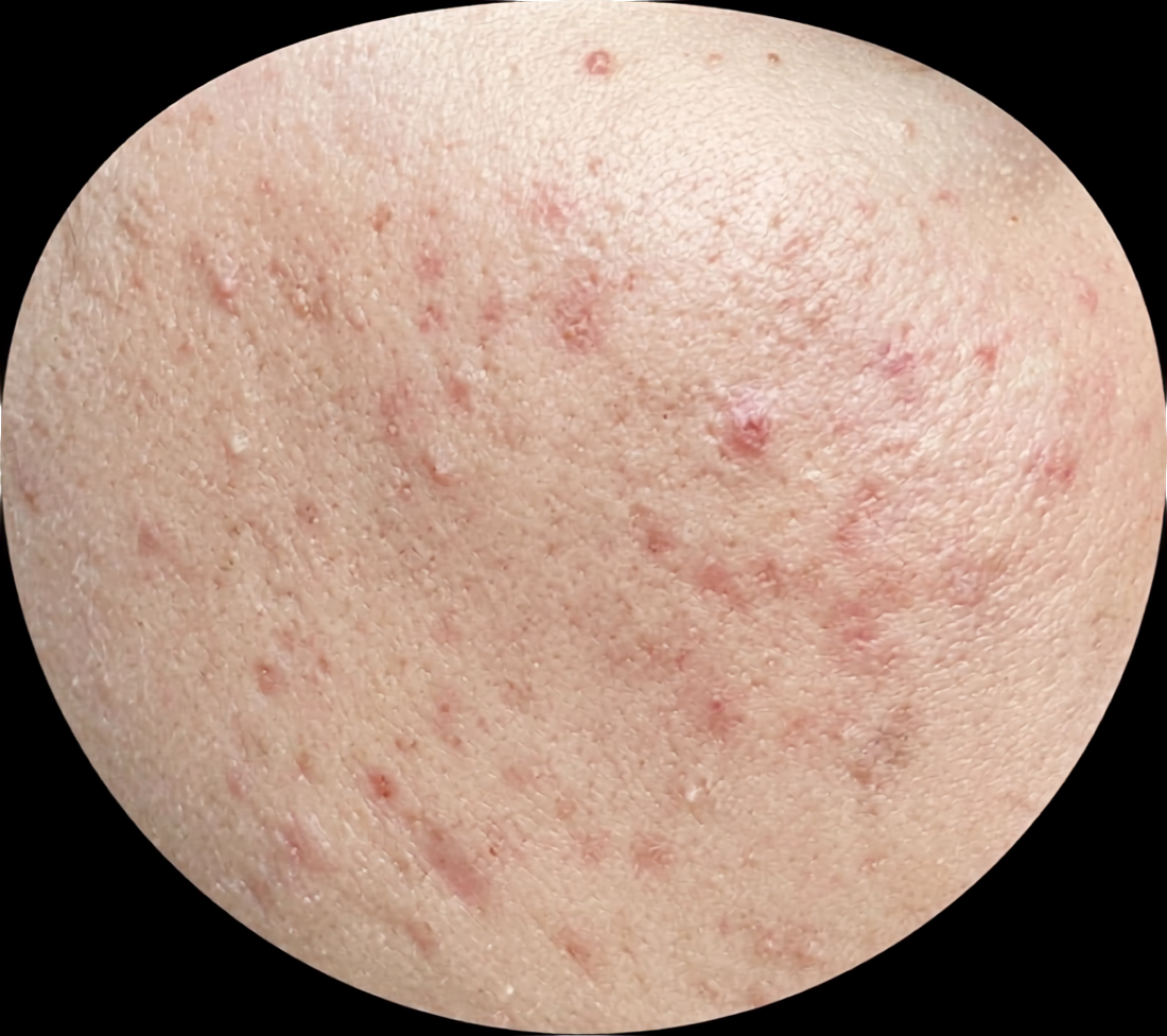 Acne Scars & Blemishes